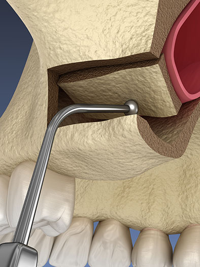 sinus lift